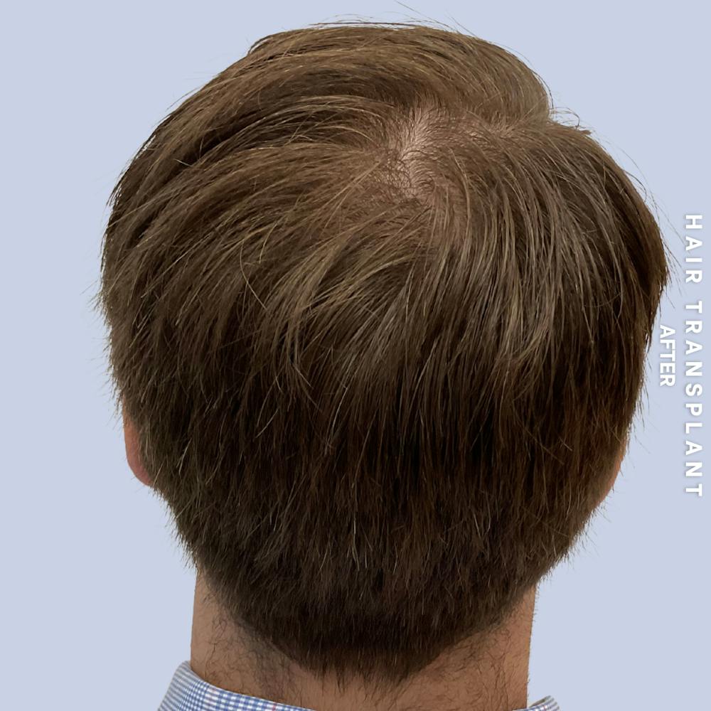 Men's Hair Before & After Gallery - Patient 125197 - Image 8