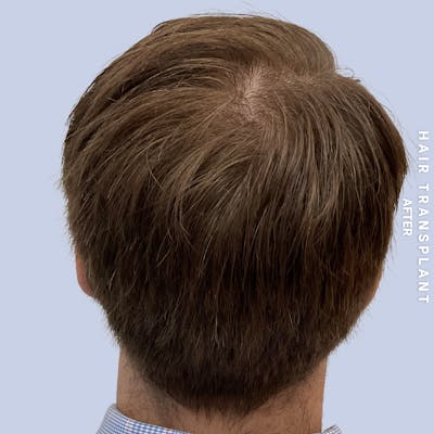 Men's Hair Before & After Gallery - Patient 125197 - Image 8