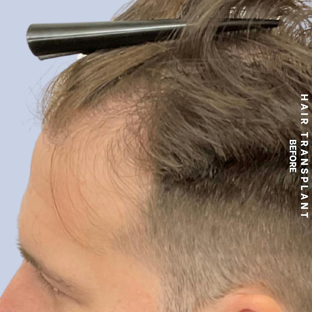 Men's Hair Before & After Gallery - Patient 125197 - Image 5