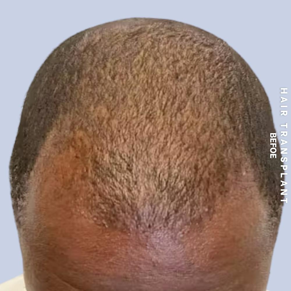 Hair Restoration Before & After Gallery - Patient 241019 - Image 1