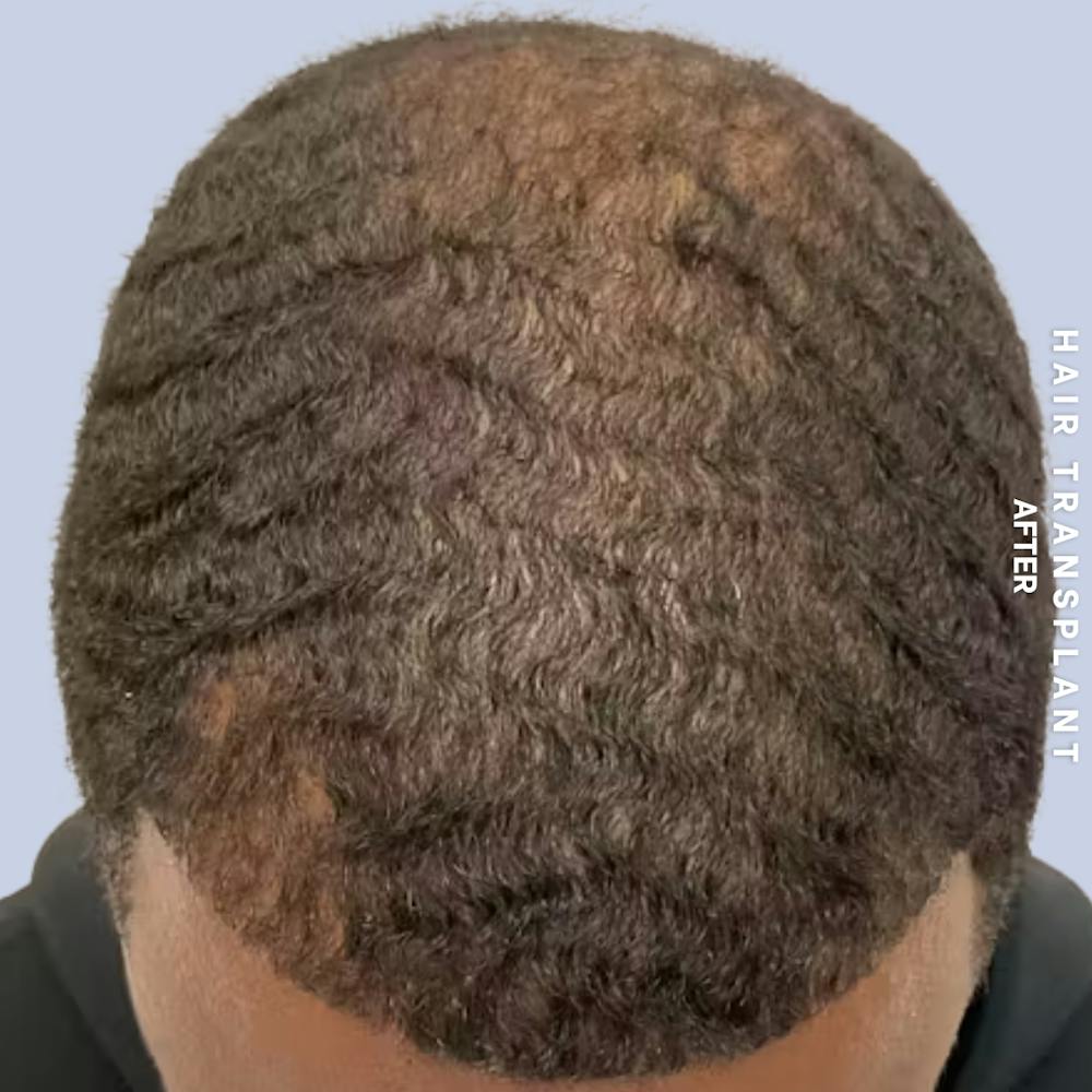 Hair Restoration Before & After Gallery - Patient 241019 - Image 2