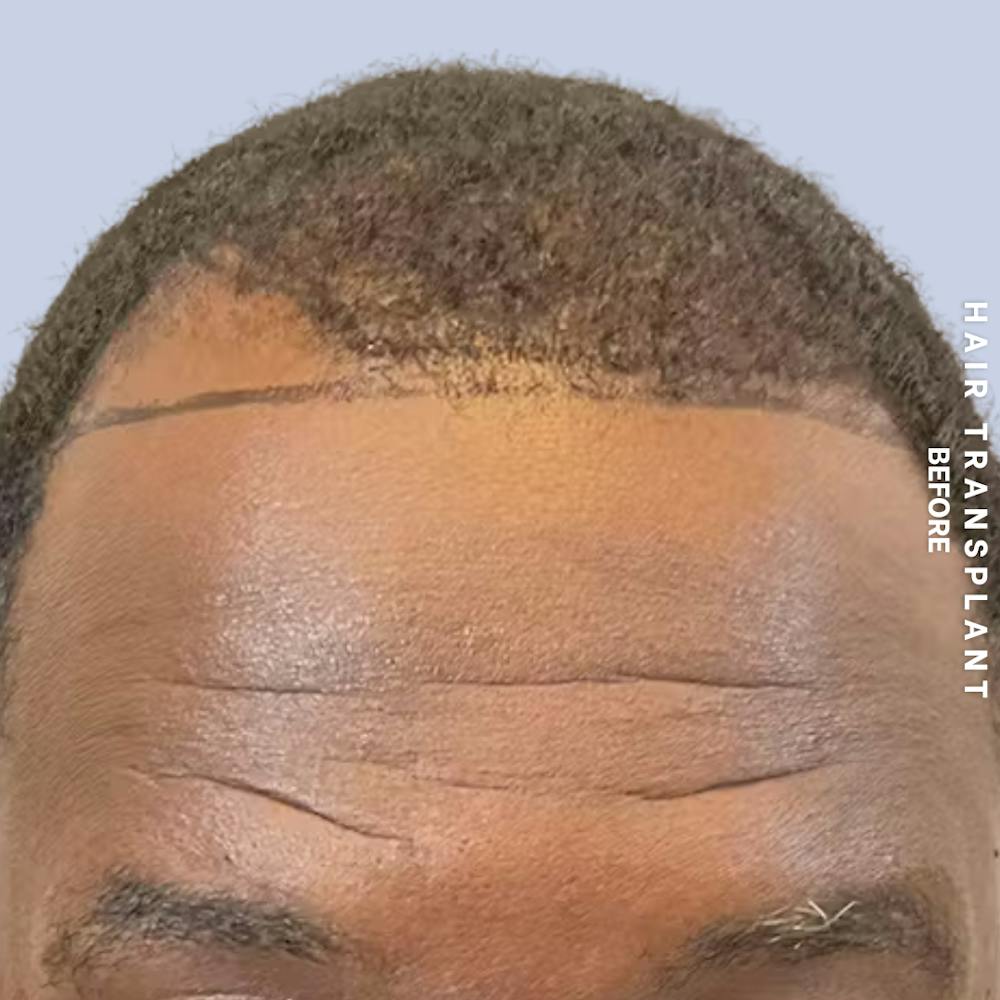 Hair Restoration Before & After Gallery - Patient 241019 - Image 3