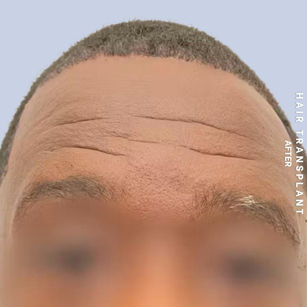Hair Restoration Before & After Gallery - Patient 241019 - Image 4