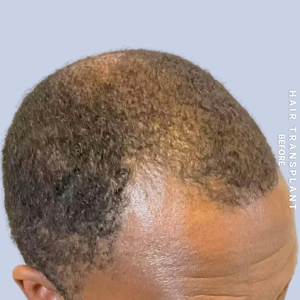 Hair Restoration Before & After Gallery - Patient 241019 - Image 5