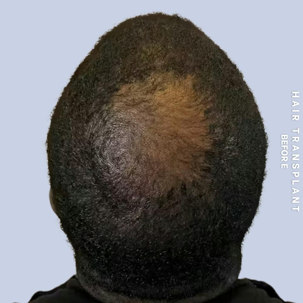 Hair Restoration Before & After Gallery - Patient 241019 - Image 7