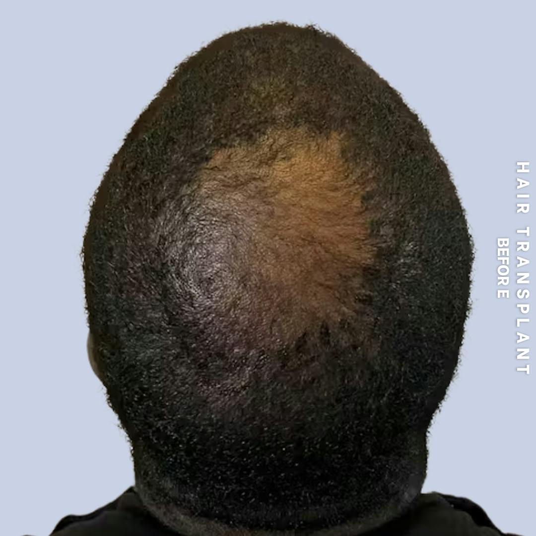 Hair Restoration Before & After Gallery - Patient 241019 - Image 7