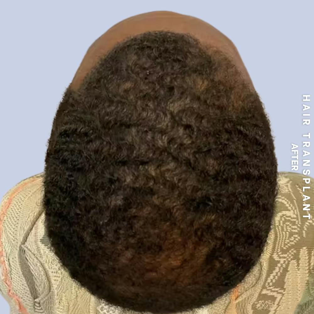 Hair Restoration Before & After Gallery - Patient 241019 - Image 8