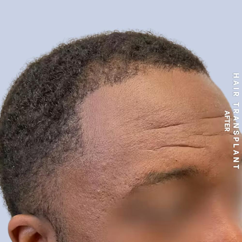 Hair Restoration Before & After Gallery - Patient 241019 - Image 6
