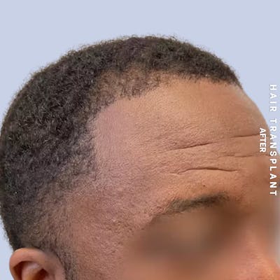 Hair Restoration Before & After Gallery - Patient 241019 - Image 6