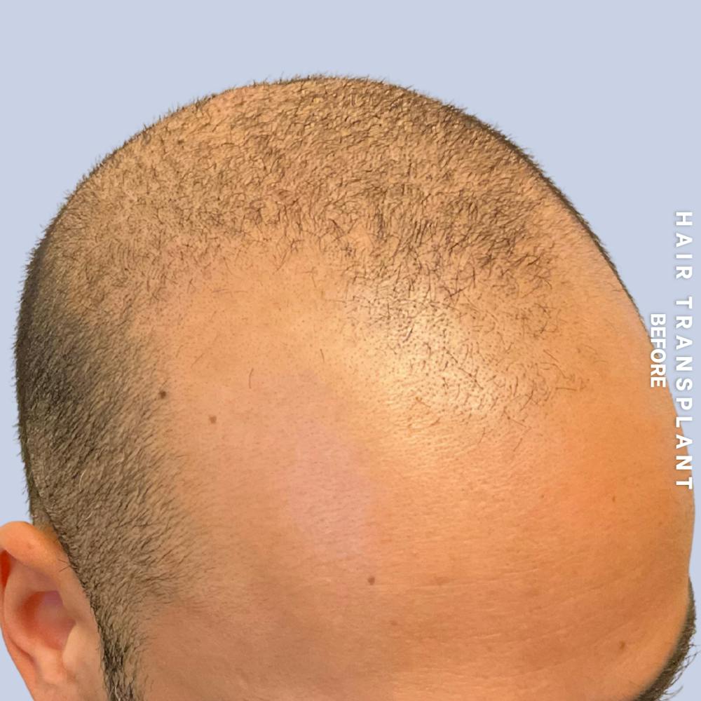 Hair Restoration Before & After Gallery - Patient 215577 - Image 3