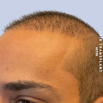 Hair Restoration Before & After Gallery - Patient 215577 - Image 6