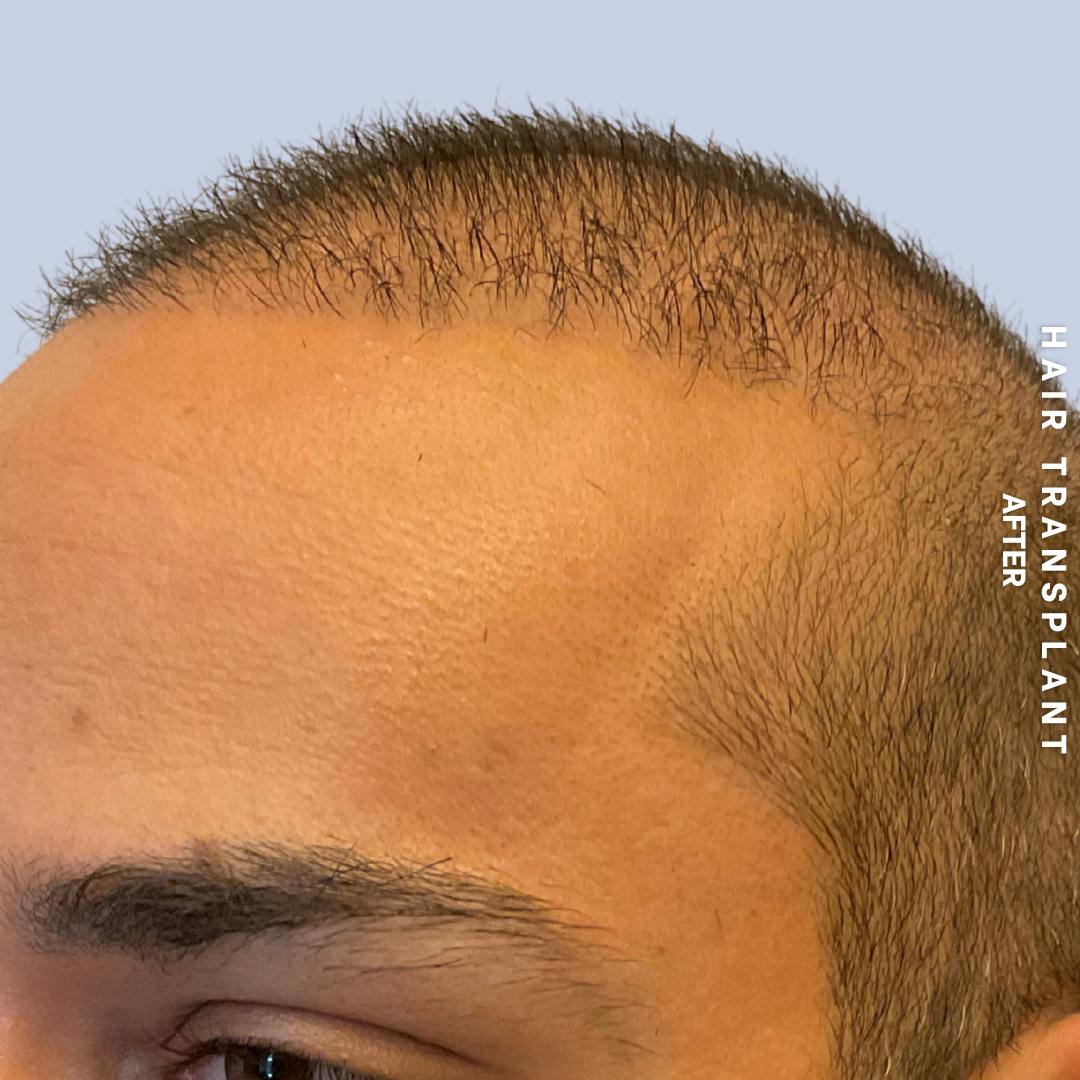 Hair Restoration Before & After Gallery - Patient 215577 - Image 6