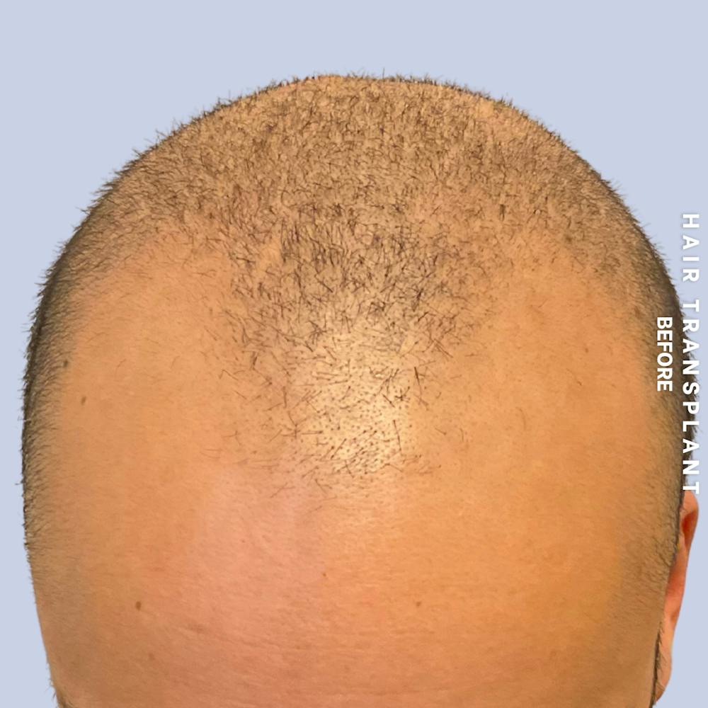 Hair Restoration Before & After Gallery - Patient 215577 - Image 1