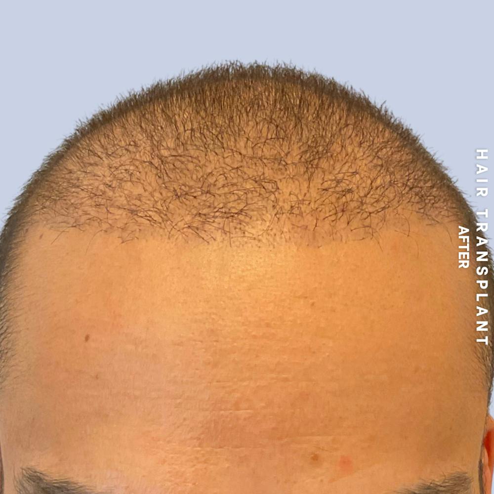 Hair Restoration Before & After Gallery - Patient 215577 - Image 2