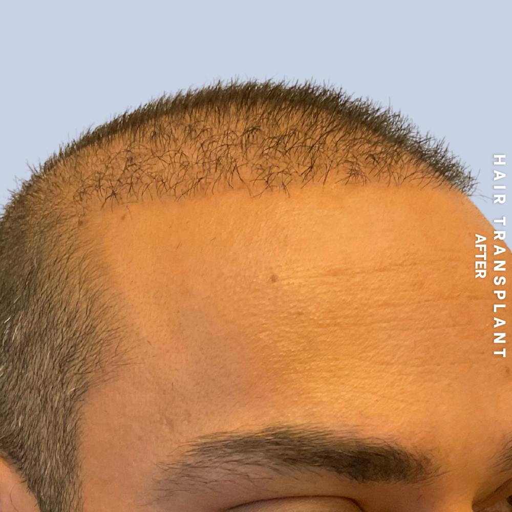 Hair Restoration Before & After Gallery - Patient 215577 - Image 4