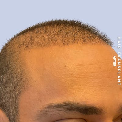Hair Restoration Before & After Gallery - Patient 215577 - Image 4