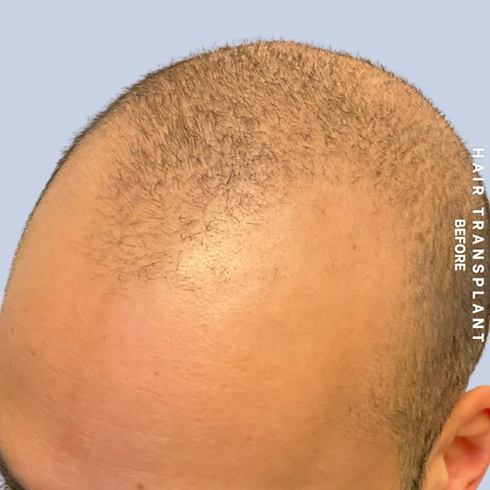 Hair Restoration Before & After Gallery - Patient 215577 - Image 5