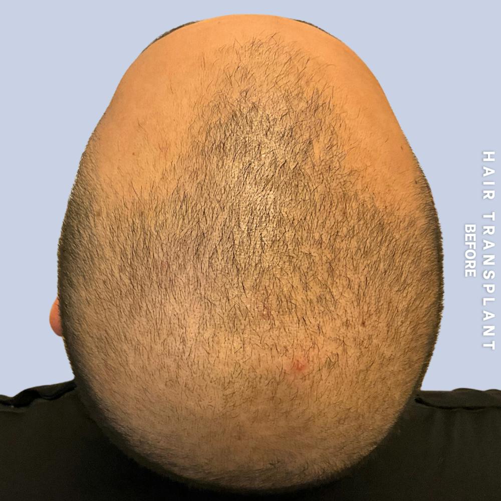 Hair Restoration Before & After Gallery - Patient 215577 - Image 7