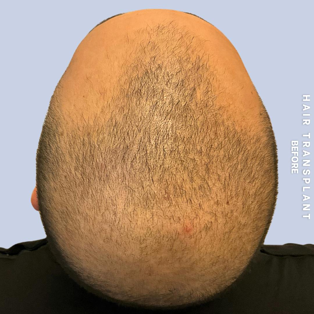 Hair Restoration Before & After Gallery - Patient 215577 - Image 7