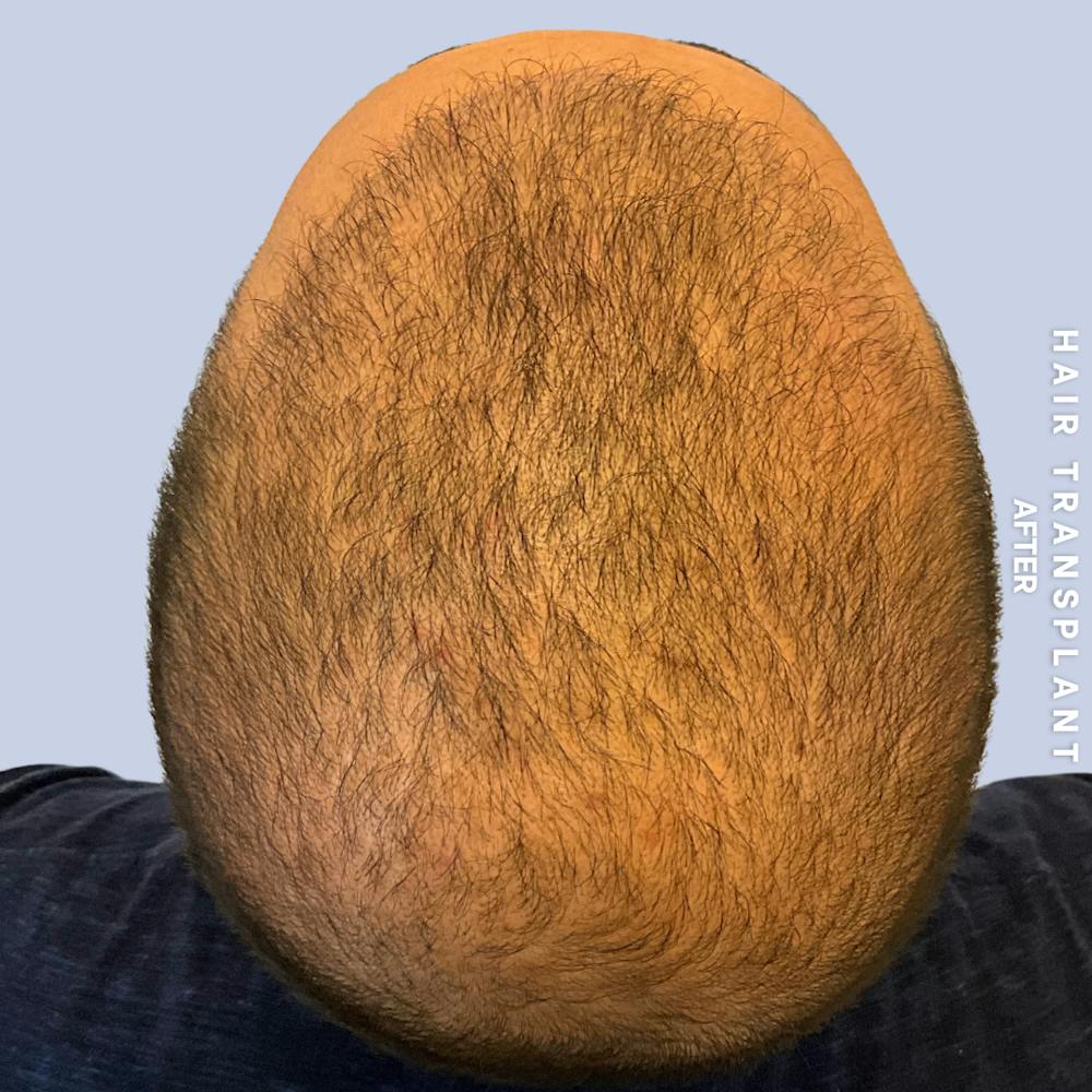 Hair Restoration Before & After Gallery - Patient 215577 - Image 8