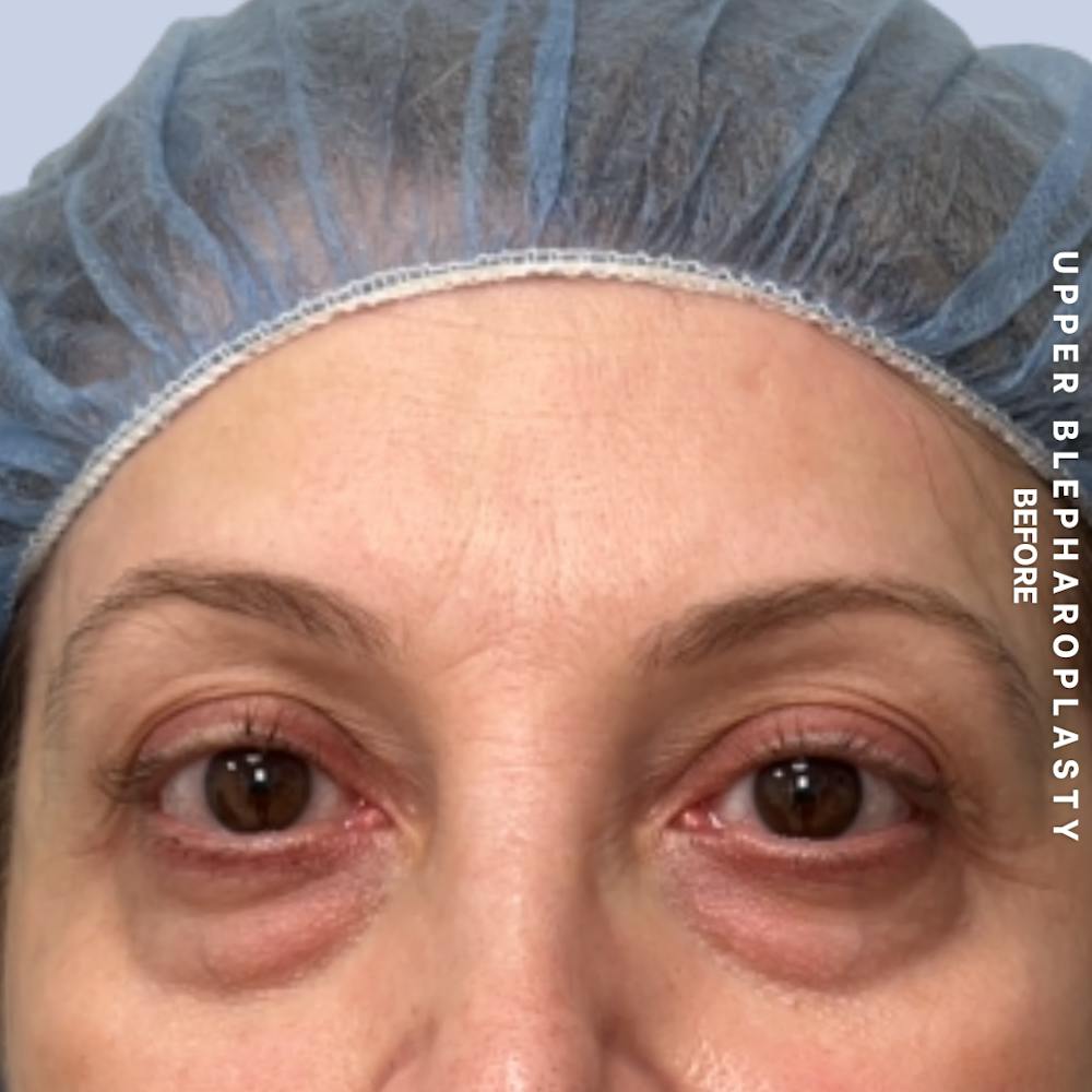 Eyes Before & After Gallery - Patient 160342 - Image 1