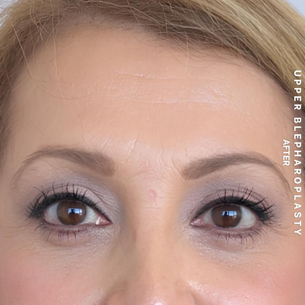 Eyes Before & After Gallery - Patient 160342 - Image 2