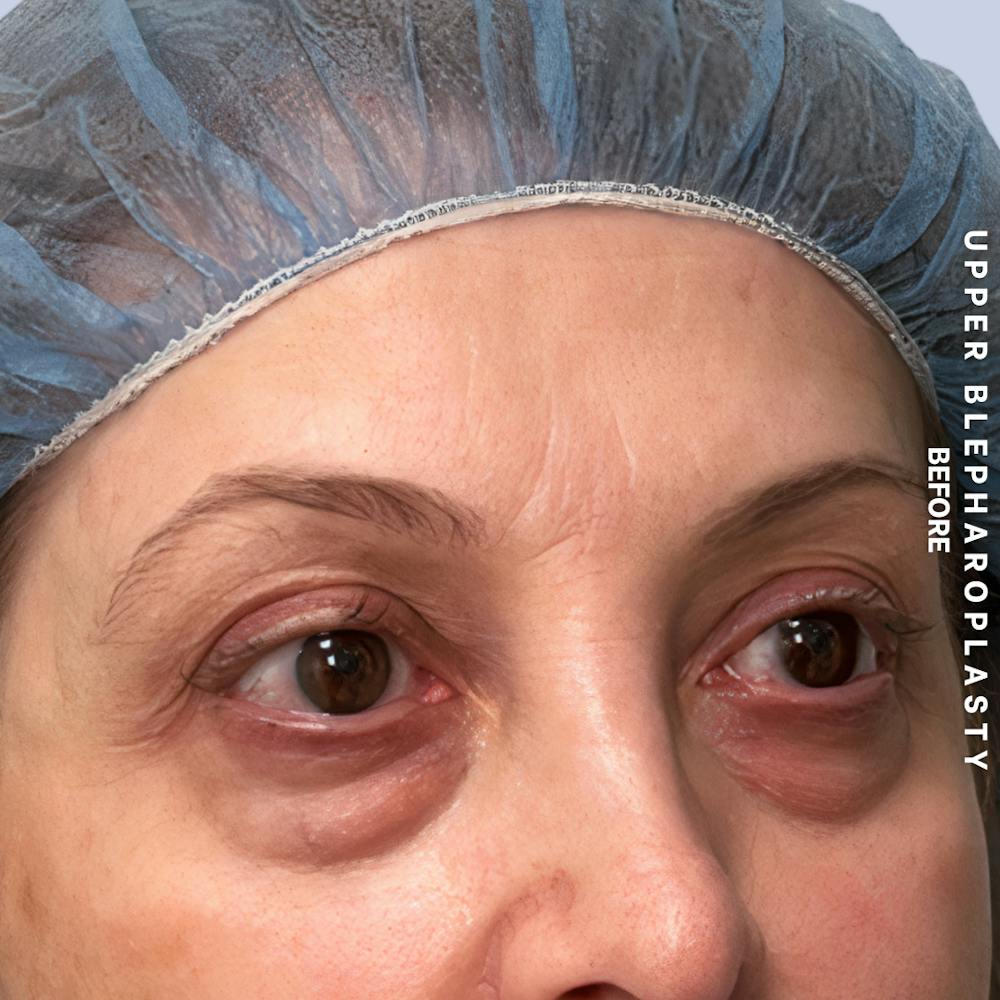 Eyes Before & After Gallery - Patient 160342 - Image 3