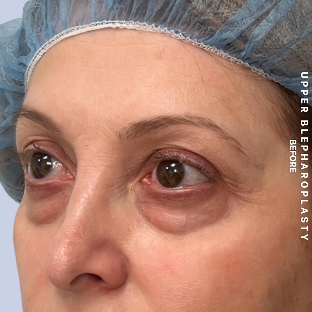 Eyes Before & After Gallery - Patient 160342 - Image 5