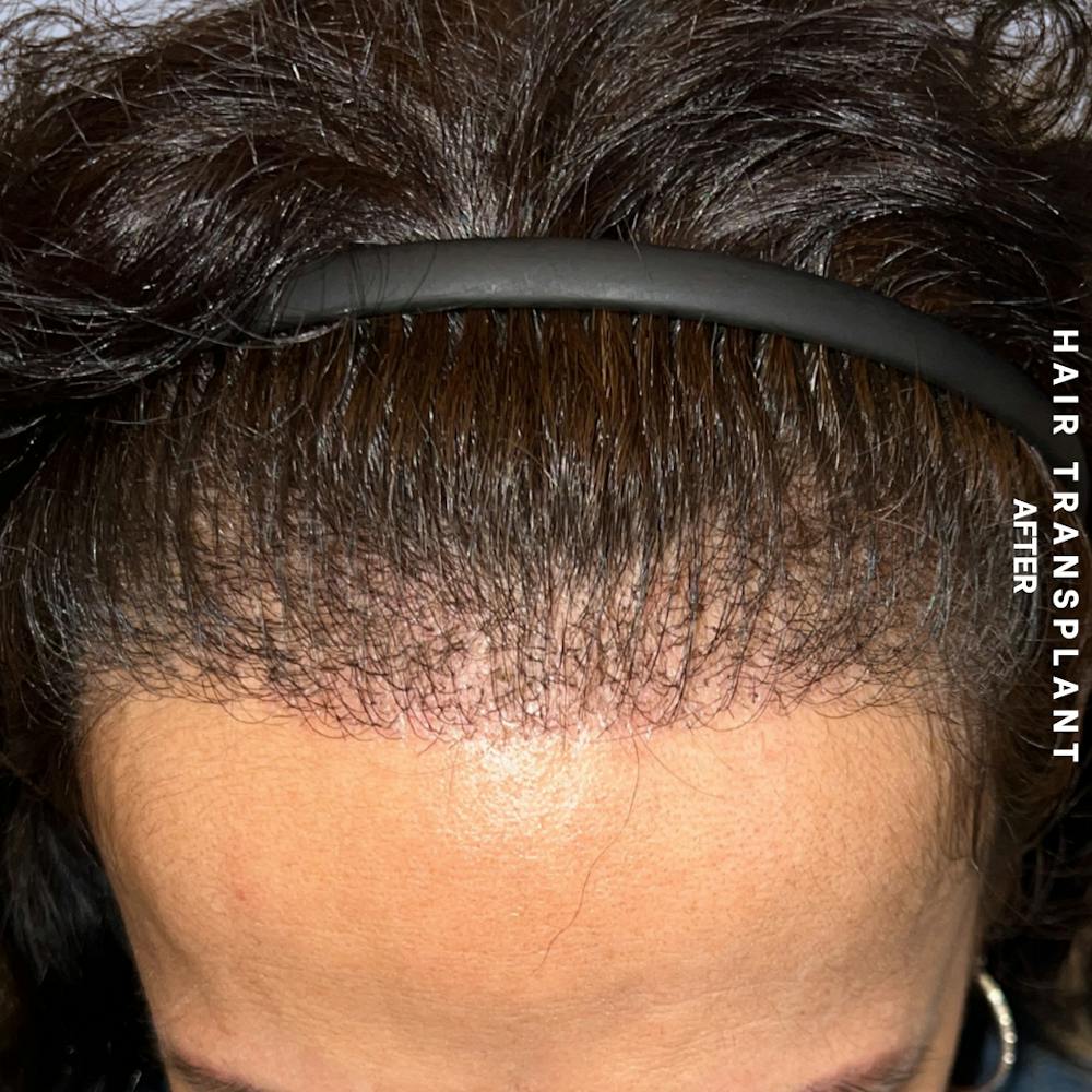 Hair Restoration Before & After Gallery - Patient 517181 - Image 2