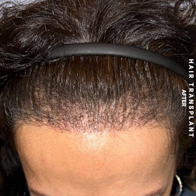 Hair Restoration Before & After Gallery - Patient 517181 - Image 2