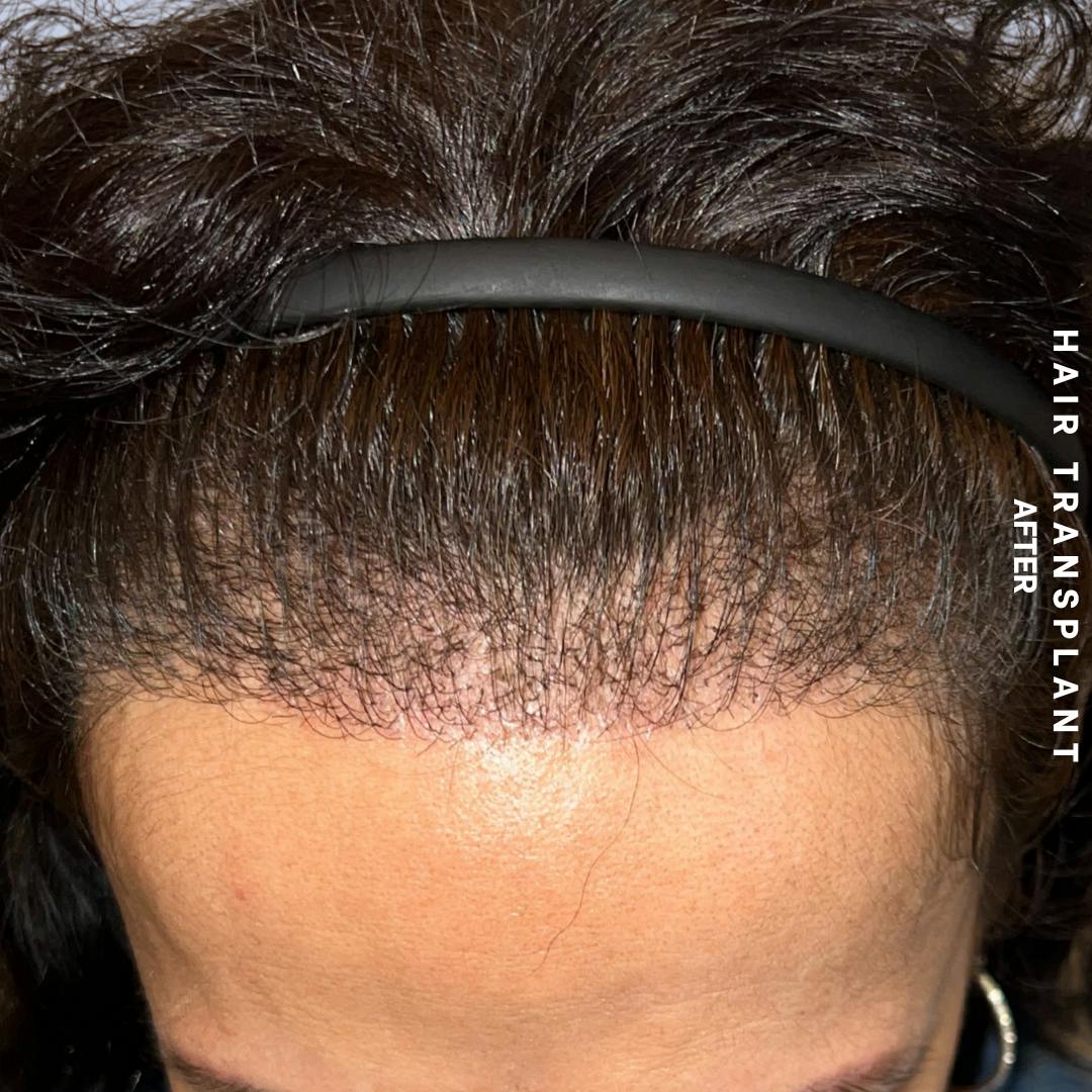 Hair Restoration Before & After Gallery - Patient 517181 - Image 2