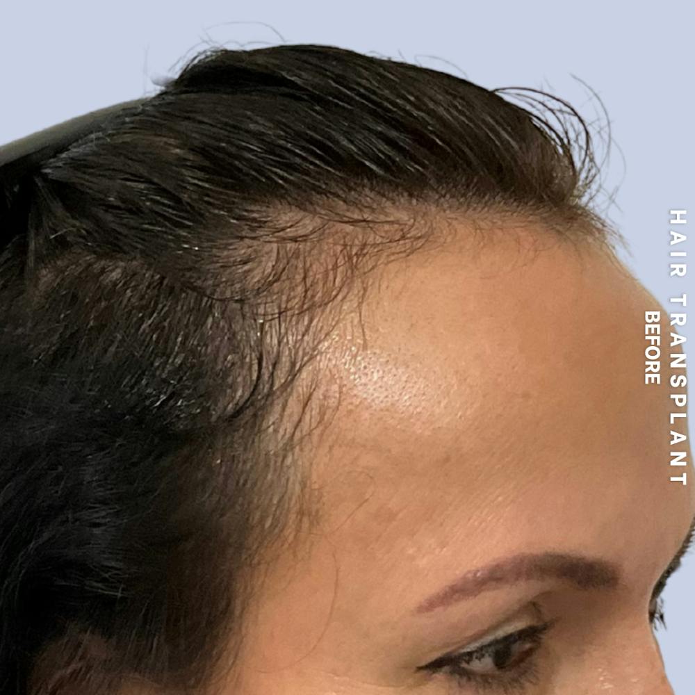 Hair Restoration Before & After Gallery - Patient 517181 - Image 3