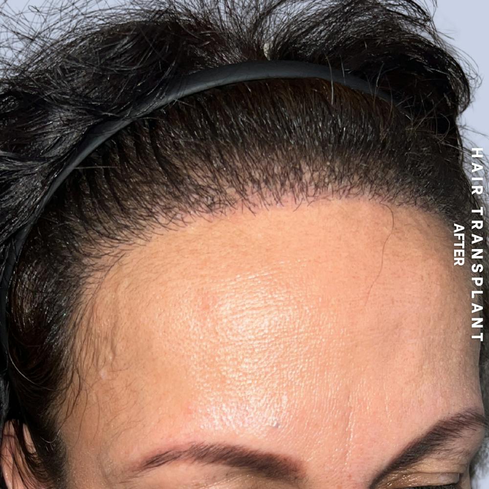Hair Restoration Before & After Gallery - Patient 517181 - Image 4