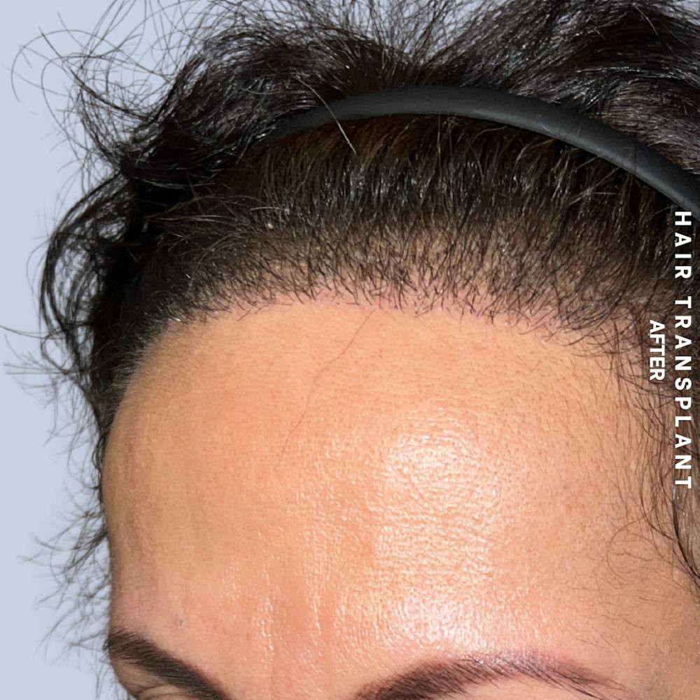 Hair Restoration Before & After Gallery - Patient 517181 - Image 6