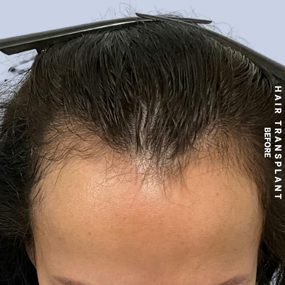 Hair Restoration Before & After Gallery - Patient 517181 - Image 1