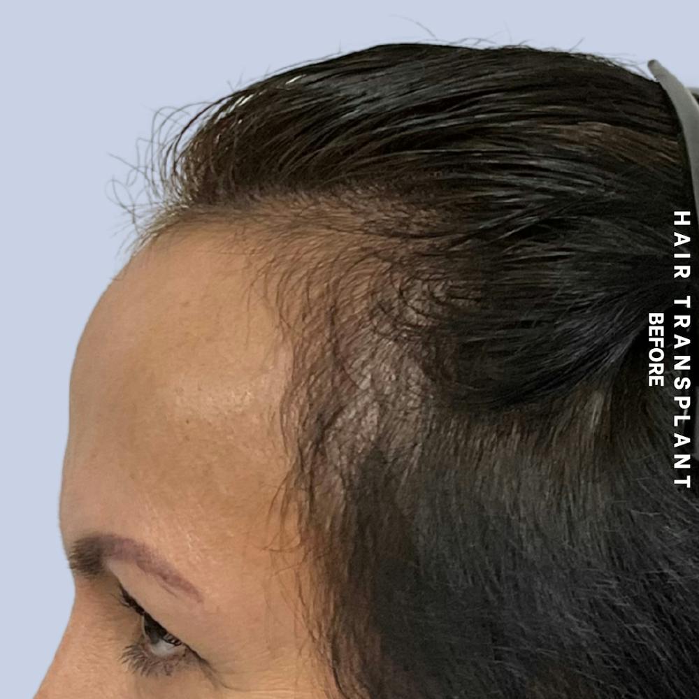 Hair Restoration Before & After Gallery - Patient 517181 - Image 5