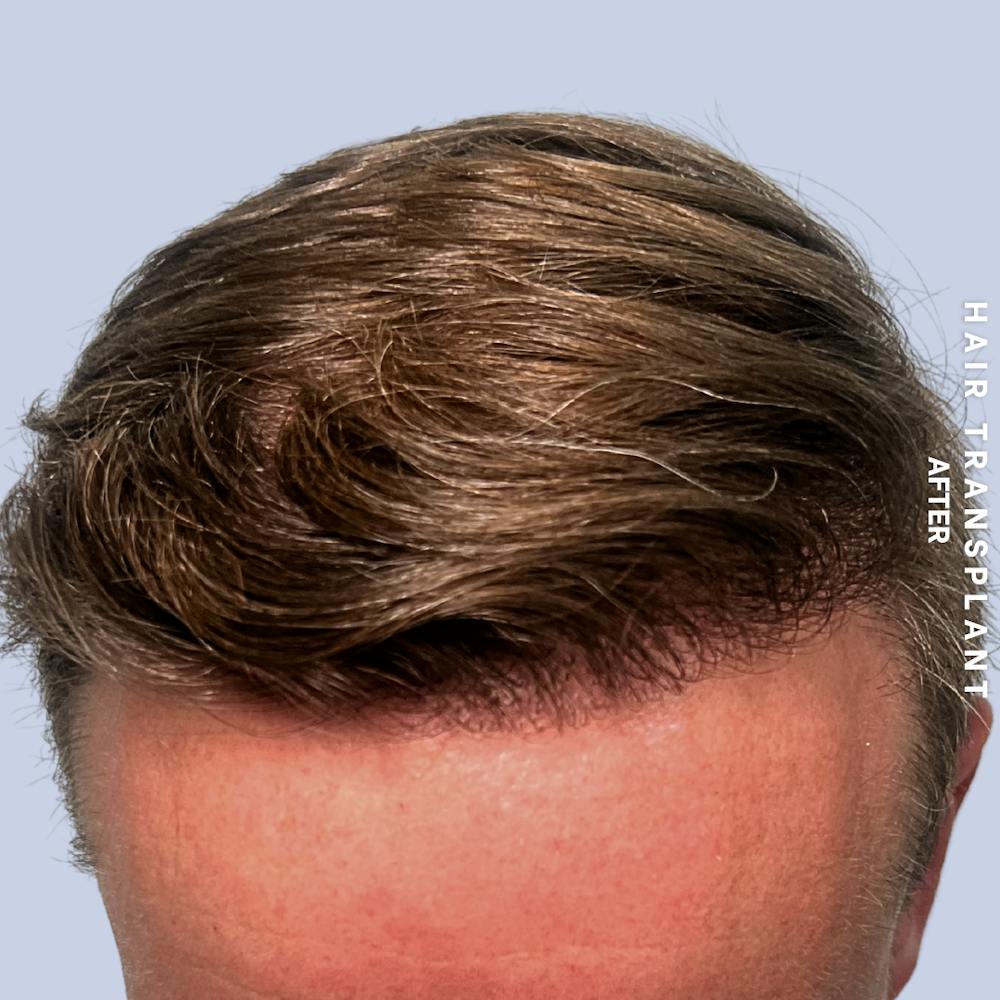 Hair Restoration Before & After Gallery - Patient 121377762 - Image 2