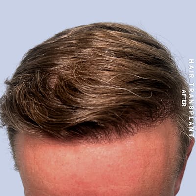 Hair Restoration Before & After Gallery - Patient 121377762 - Image 2