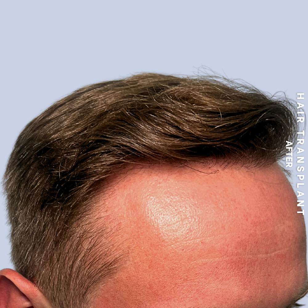 Hair Restoration Before & After Gallery - Patient 121377762 - Image 4