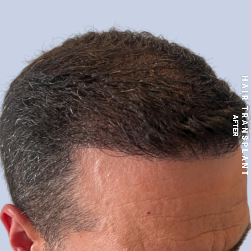 Men's Hair Before & After Gallery - Patient 174166 - Image 2