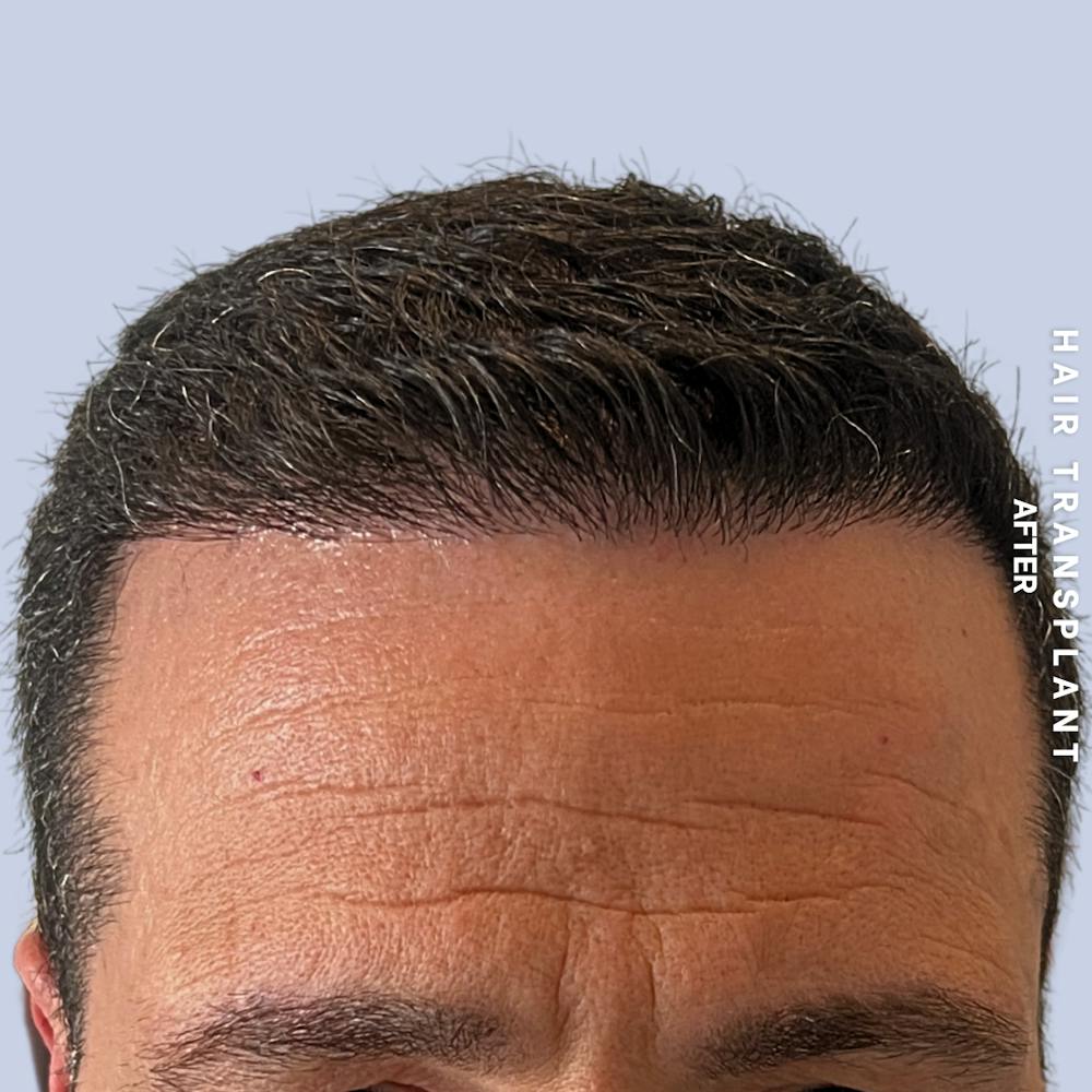 Men's Hair Before & After Gallery - Patient 174166 - Image 4