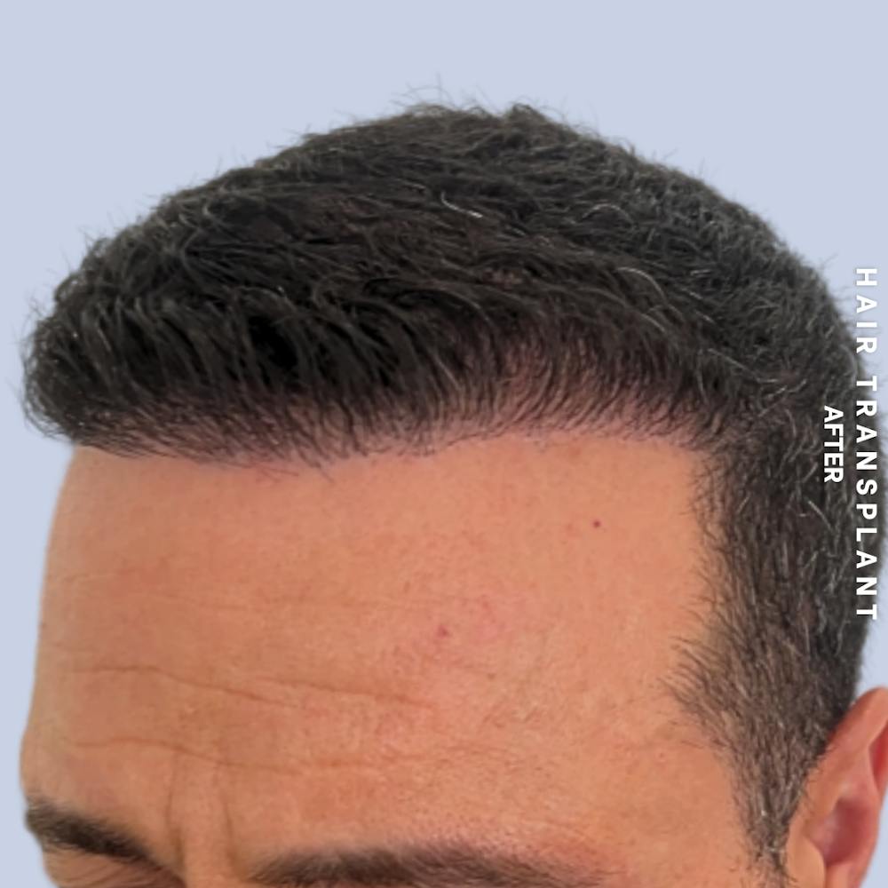 Men's Hair Before & After Gallery - Patient 174166 - Image 6