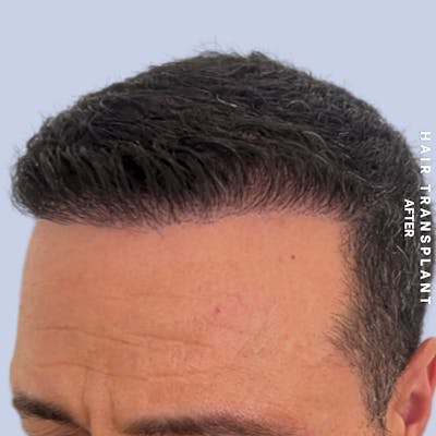 Men's Hair Before & After Gallery - Patient 174166 - Image 6