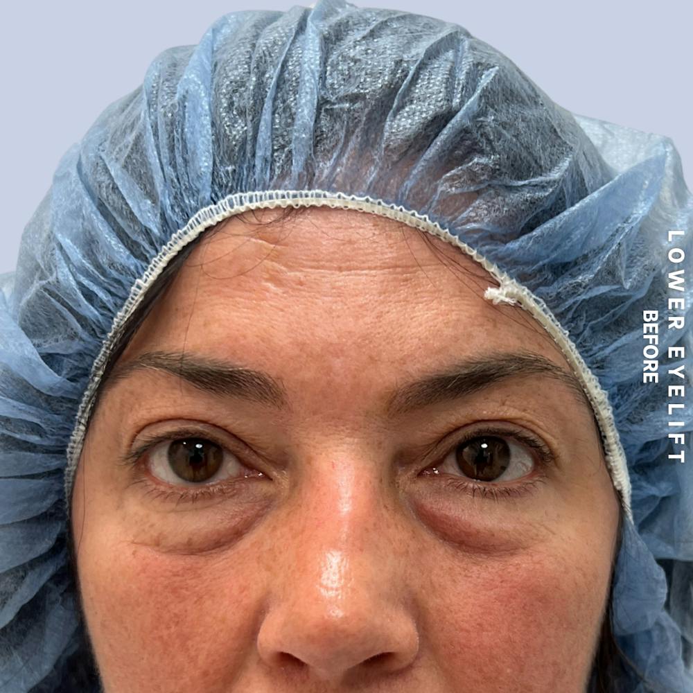 Eyes Before & After Gallery - Patient 143724 - Image 1