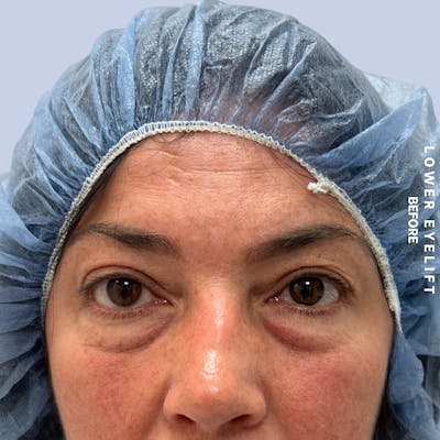 Eyes Before & After Gallery - Patient 143724 - Image 1