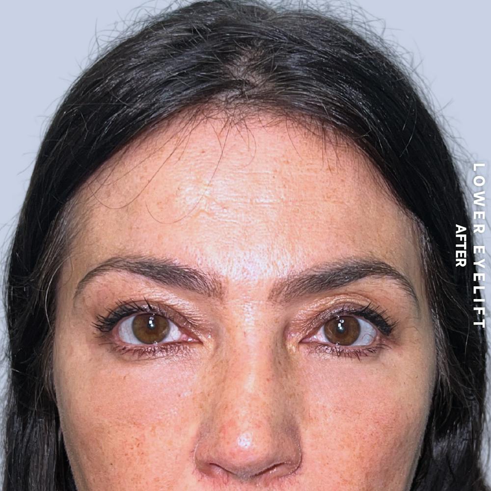 Eyes Before & After Gallery - Patient 143724 - Image 2