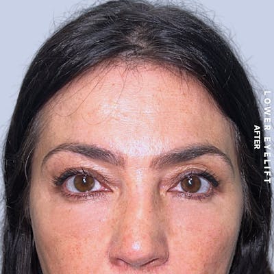 Eyes Before & After Gallery - Patient 143724 - Image 2