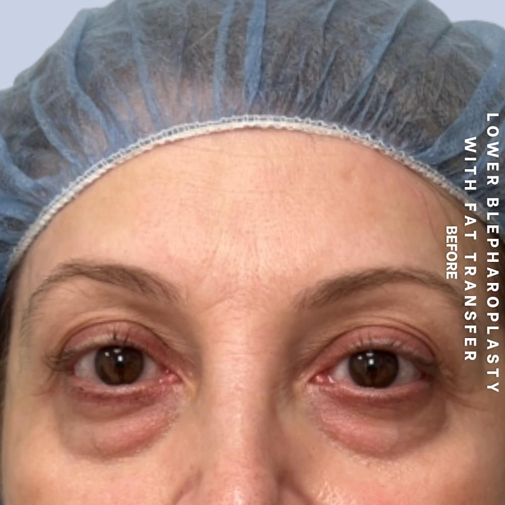 Eyes Before & After Gallery - Patient 160342 - Image 1