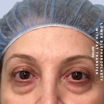 Eyes Before & After Gallery - Patient 160342 - Image 1