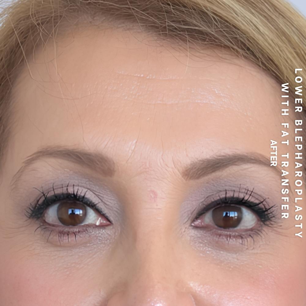 Eyes Before & After Gallery - Patient 160342 - Image 2